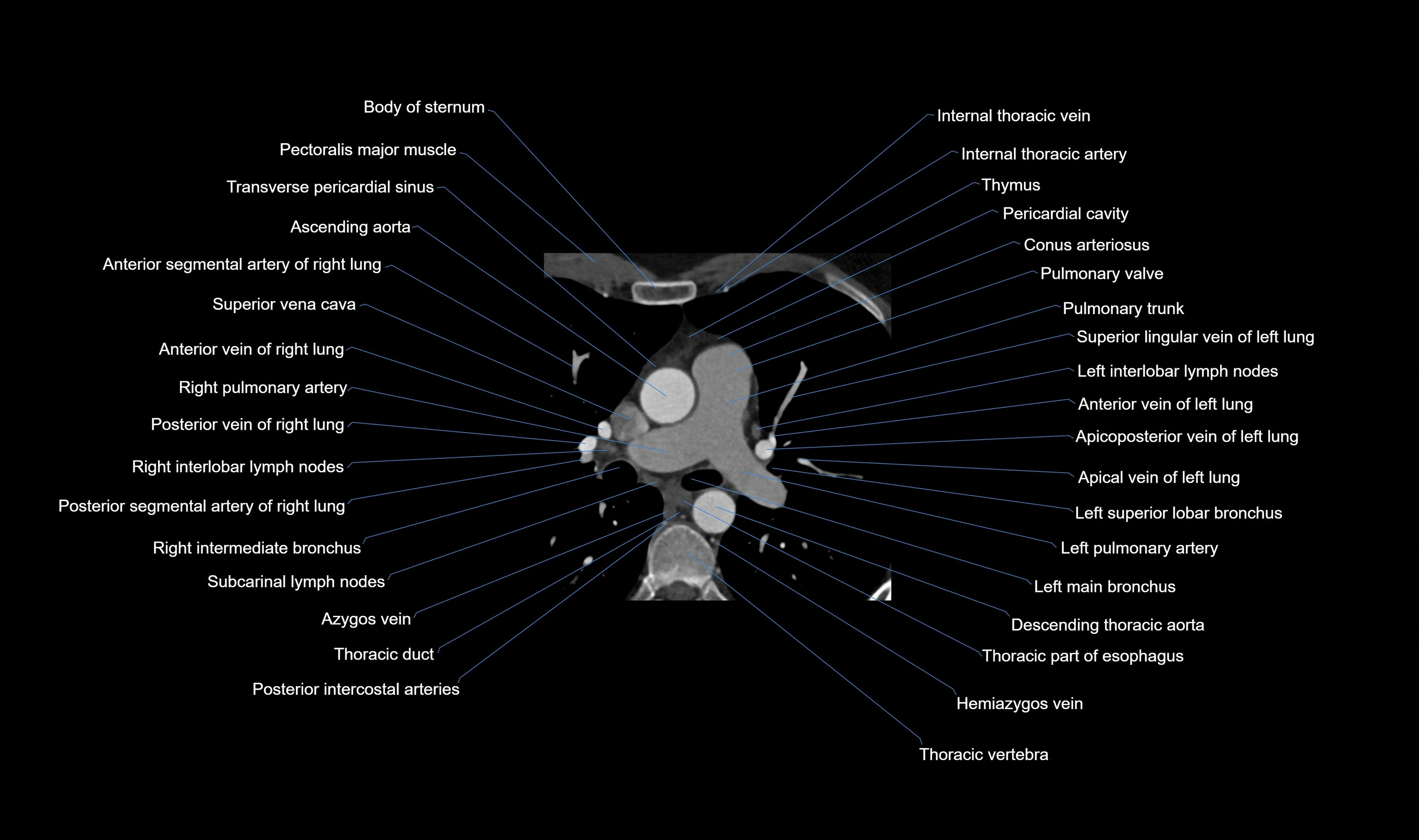 CT heart (coronary angiogram) axial view cross sectional anatomy labelled radiology image-00013.webp